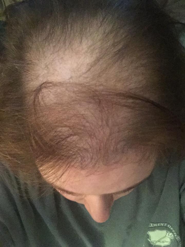 Explaining My Hair Loss to My Daughter - alopecia and female pattern baldness due to chemotherapy