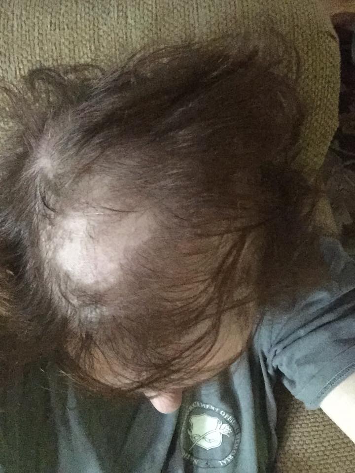 Explaining My Hair Loss to My Daughter - alopecia and female pattern baldness due to chemotherapy